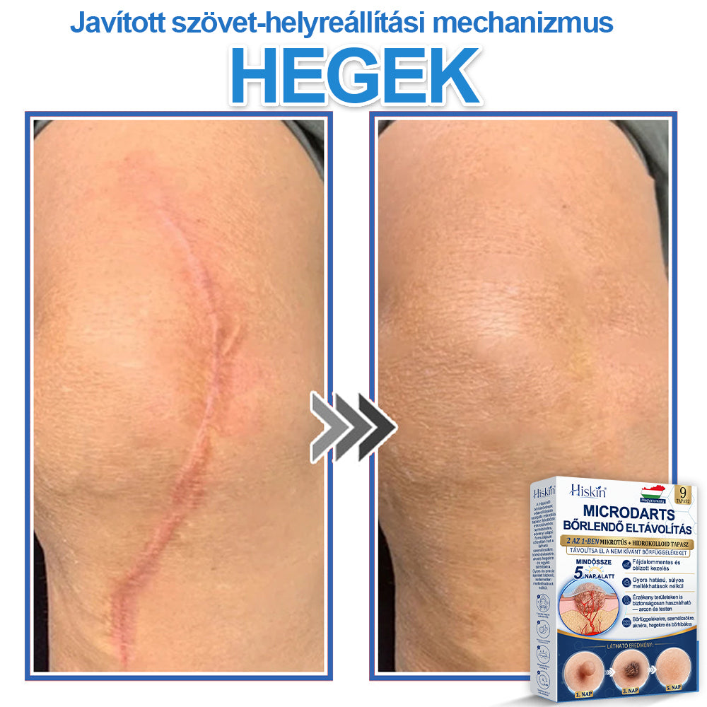 👩‍⚕️ 𝐇𝐢𝐬𝐤𝐢𝐧® 𝟐 𝐚𝐳 𝟏-𝐛𝐞𝐧 𝐌𝐢𝐤𝐫𝐨𝐭ű𝐬 & 𝐇𝐢𝐝𝐫𝐨𝐤𝐨𝐥𝐥𝐨𝐢𝐝 𝐓𝐚𝐩𝐚𝐬𝐳 | 𝐊𝐢𝐞𝐦𝐞𝐥𝐤𝐞𝐝ő 𝐚𝐧𝐲𝐚𝐣𝐞𝐠𝐲𝐞𝐤, 𝐚𝐤𝐧é, 𝐥𝐚𝐩𝐨𝐬 𝐬𝐳𝐞𝐦ö𝐥𝐜𝐬ö𝐤 é𝐬 𝐛ő𝐫𝐤𝐢𝐧ö𝐯é𝐬𝐞𝐤 𝐞𝐥𝐭á𝐯𝐨𝐥í𝐭á𝐬á𝐫𝐚 | 𝐒𝐞𝐠í𝐭 𝐣𝐚𝐯í𝐭𝐚𝐧𝐢 𝐚 𝐫á𝐧𝐜𝐨𝐤, 𝐡𝐞𝐠𝐞𝐤 é𝐬 𝐛ő𝐫𝐡𝐢𝐛á𝐤 𝐦𝐞𝐠𝐣𝐞𝐥𝐞𝐧é𝐬é𝐭 | 𝐋á𝐭𝐡𝐚𝐭𝐚𝐭𝐥𝐚𝐧 𝐜𝐬𝐢𝐥𝐥𝐚𝐠 𝐚𝐥𝐚𝐤ú 𝐩𝐚𝐭𝐭𝐚𝐧á𝐬𝐭𝐚𝐩𝐚𝐬𝐳 𝐚𝐫𝐜𝐫𝐚 é𝐬 𝐭𝐞𝐬𝐭𝐫𝐞